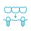 Implant-Overdentures